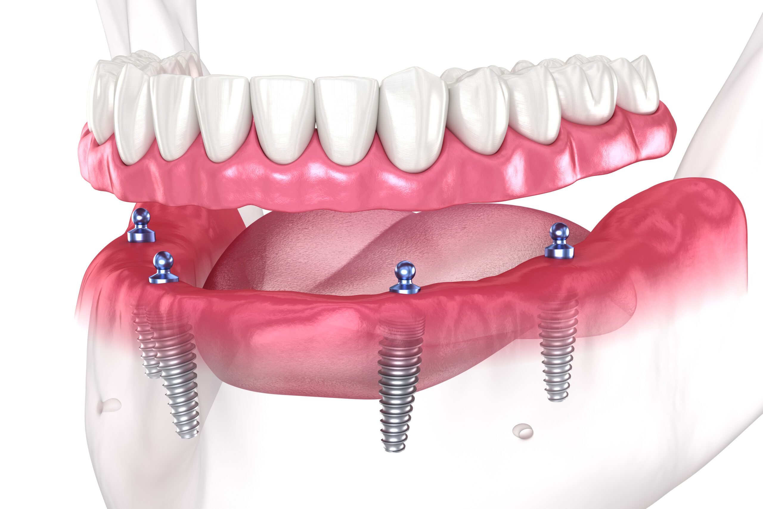 Unveiling New Possibilities with Customised Dental Implants